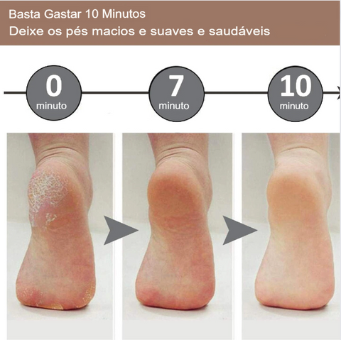 Removedor De Calos e Rachaduras Nos Pés 2 Removedor De Calos E Rachaduras Nos Pés