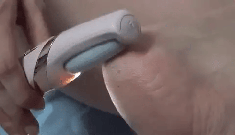 Removedor De Calos e Rachaduras Nos Pés 1 Removedor De Calos E Rachaduras Nos Pés